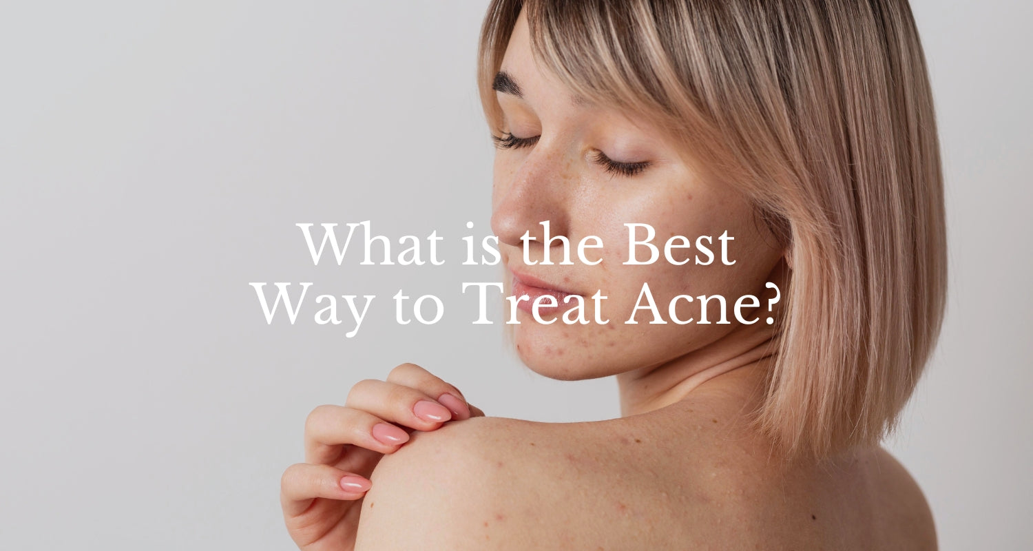 What is the Best Way to Treat Acne?