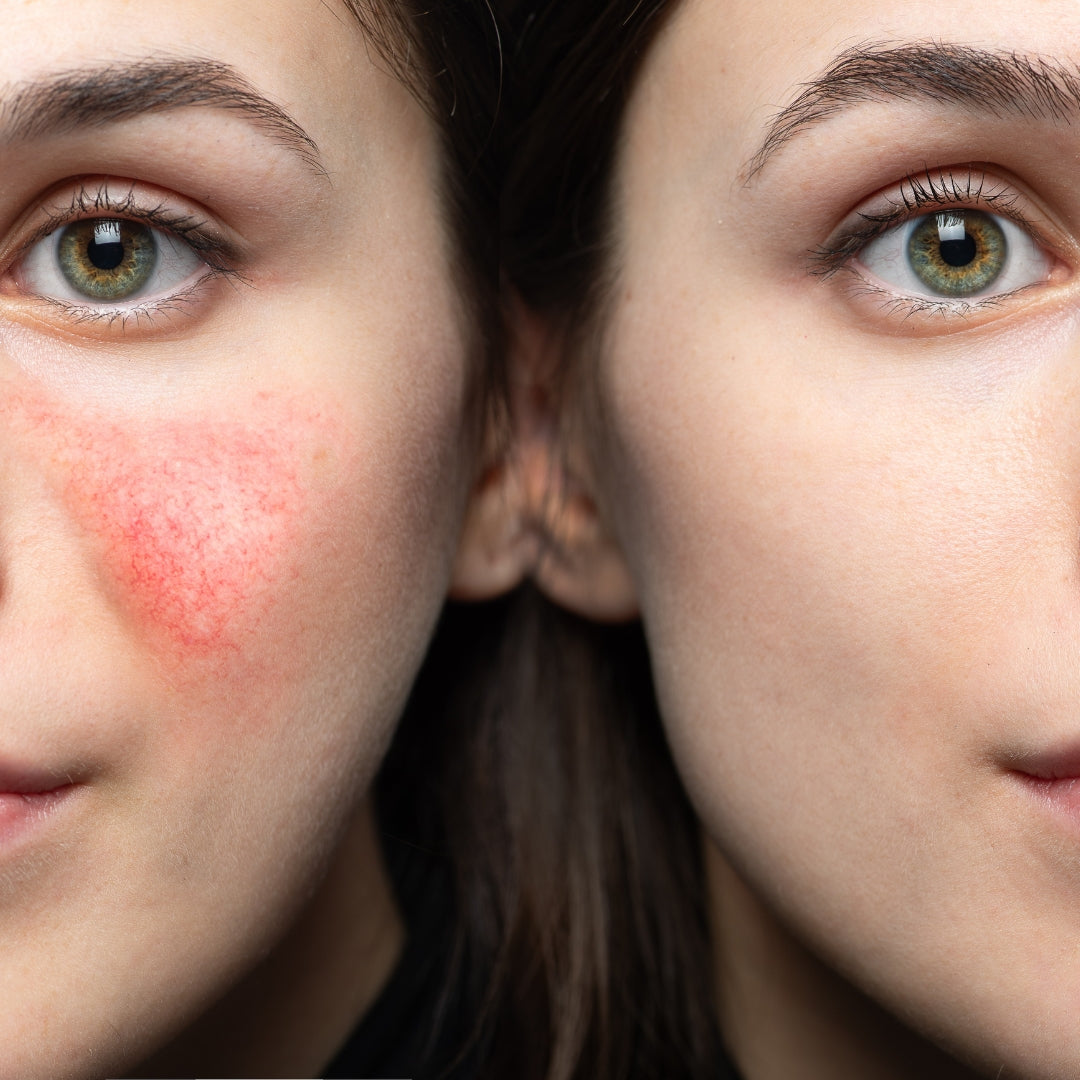 ROSACEA SKIN HEALTH SYSTEM