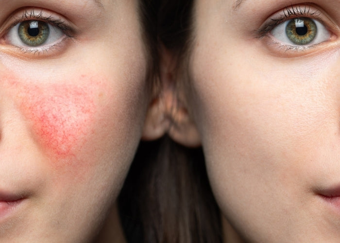 ROSACEA SKIN HEALTH SYSTEM